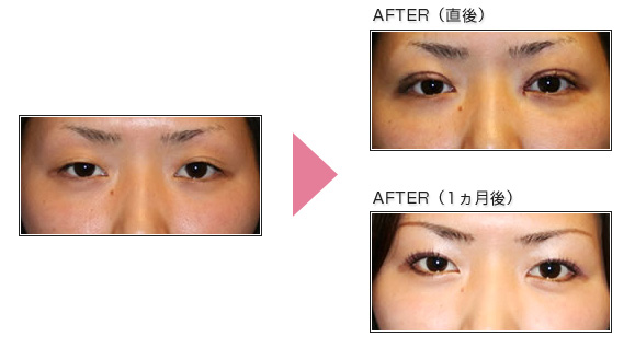 目頭切開（クイック法併用）の施術前後