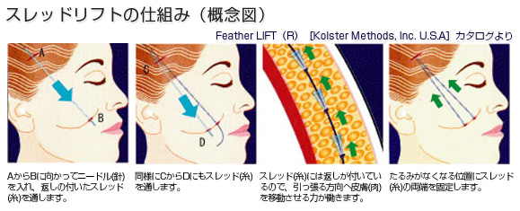 スレッドリフトの仕組み（概念図）